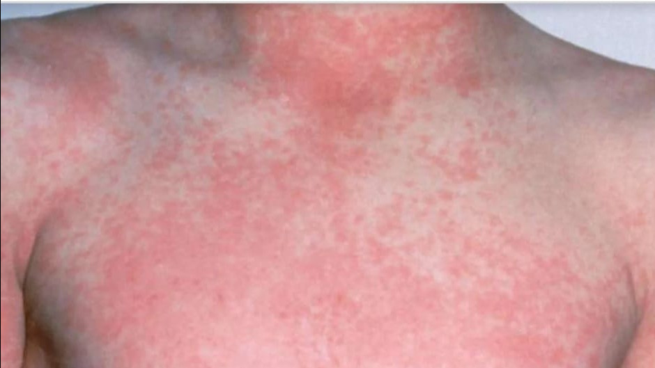 Escarlatina o Fiebre Escarlata: síntomas y forma de prevenirla | IPAP
